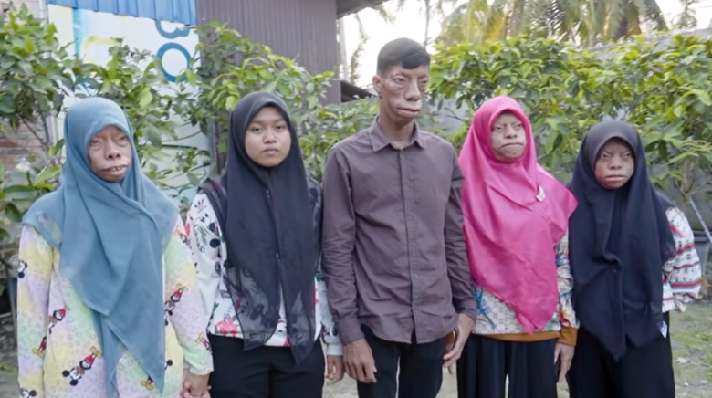 Indonesian Family Whose Faces Change Shape