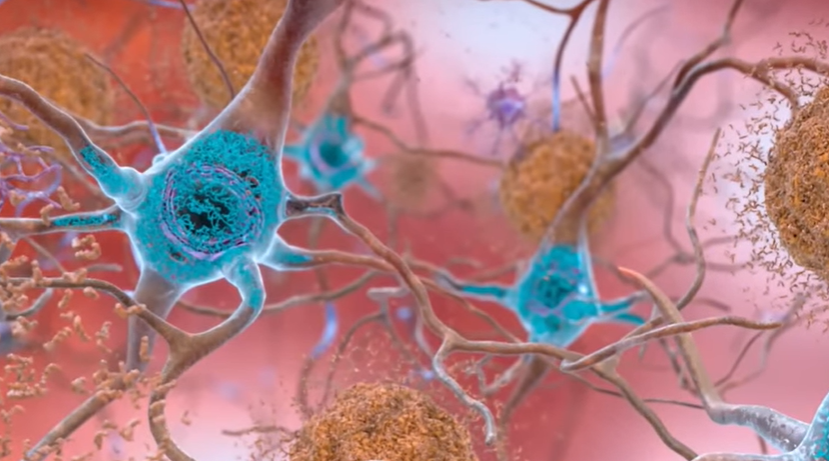 New Alzheimer's Drug Offers Hope to Patients and Caregivers
