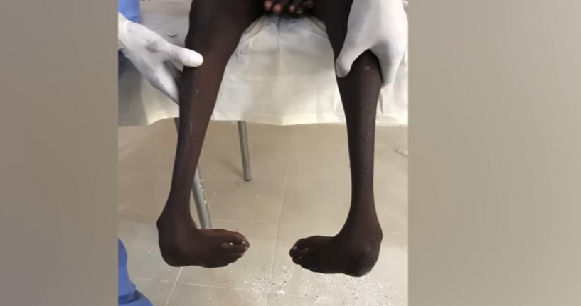 How Clubfoot Treatment is Transforming Senegalese Children's Lives