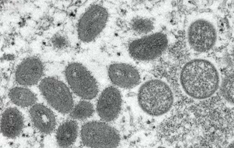 Monkeypox Case in Massachusetts